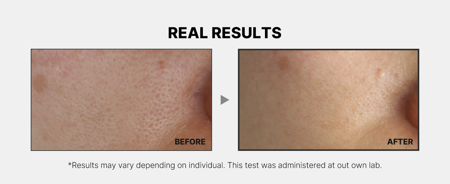 AGE-R ATS AIR SHOT, NEEDLE-FREE PORE REFINING DEVICE, TIGHTEN AND SMOOTHEN SKIN TEXTURE IN MINUTES