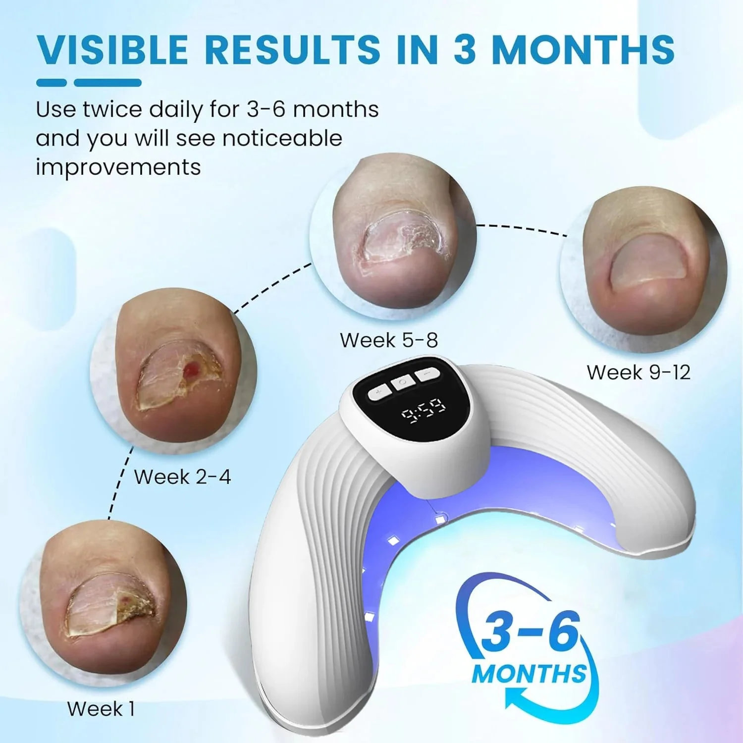 Laser Nail Fungus Treatment Device – Removes Toenail & Fingernail Fungus, Effective Onychomycosis Cure for Fungal Infections