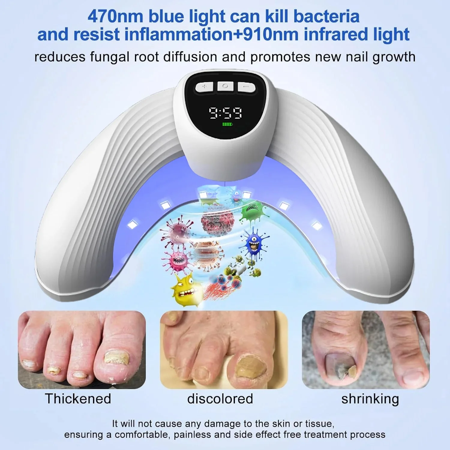 Laser Nail Fungus Treatment Device – Removes Toenail & Fingernail Fungus, Effective Onychomycosis Cure for Fungal Infections